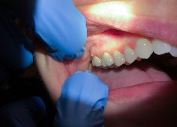 Best Emergency Cosmetic Dentistry (e.g., broken veneers) in Yarrow Point, WA