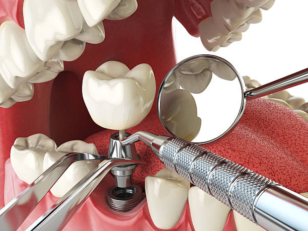 Best Knocked-Out Tooth (Avulsed Tooth) Treatment in Yarrow Point, WA
